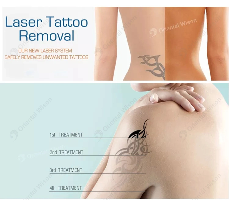 ND YAG LASER Pico Tattoo picoseconde tache sombre La pigmentation de la dépose du matériel médical laser peeling Éclaircissement de la peau de carbone