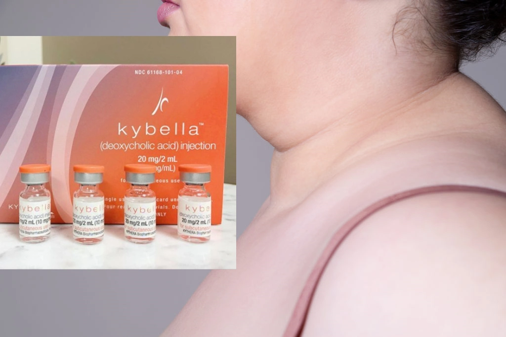 Kybella Kabelline redução da gordura do queixo duplo tratamento aprovado pela FDA Kybella dissolve a camada subjacente de gordura antes e após as fotos dos produtos da perda de peso