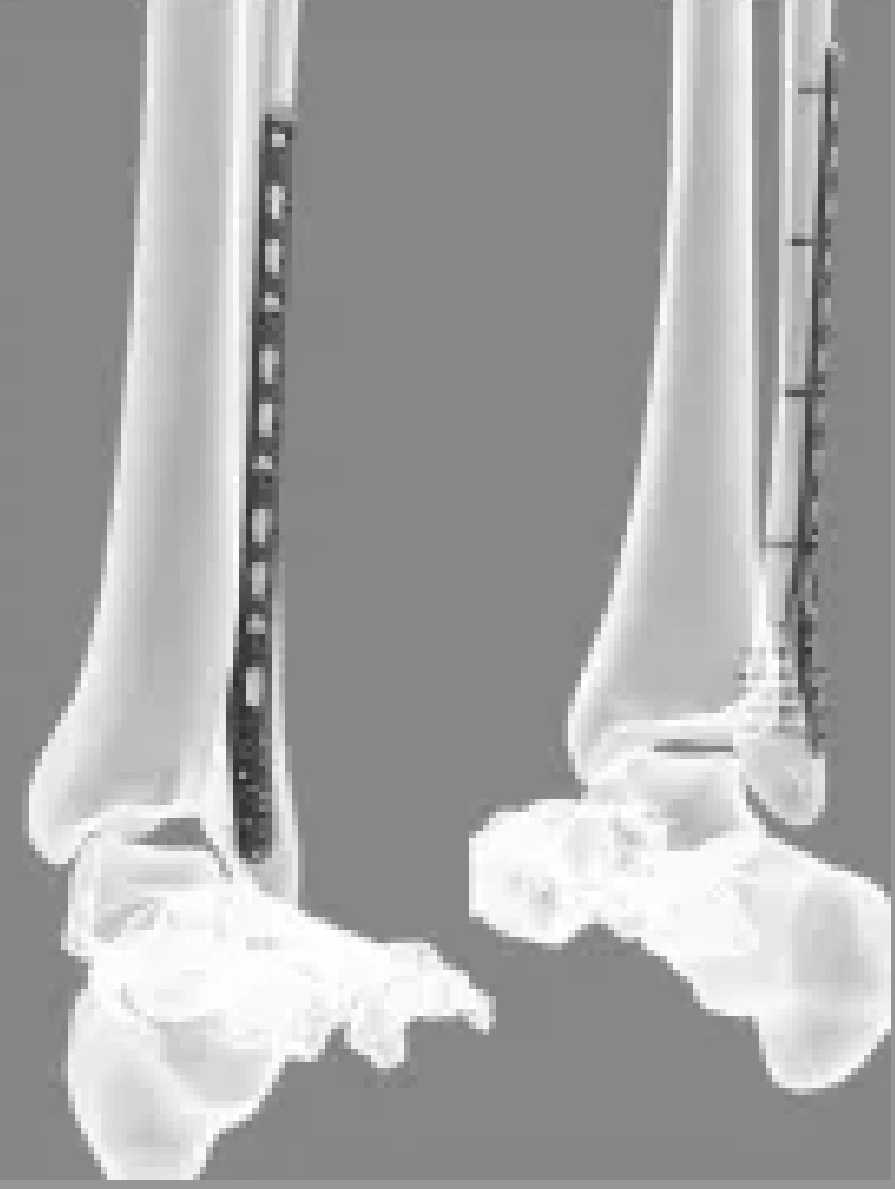 El trauma quirúrgico implantes ortopédicos de peroné Distal Posterolateral Chapa