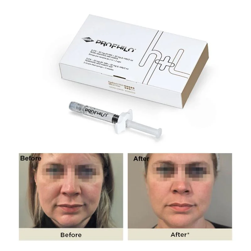 Enchimento dérmico de injeção anti-rugas Profilo H e L original eficiente elevação facial E melhora da pele Pdrn estimulando colágeno Profhilo 2ml