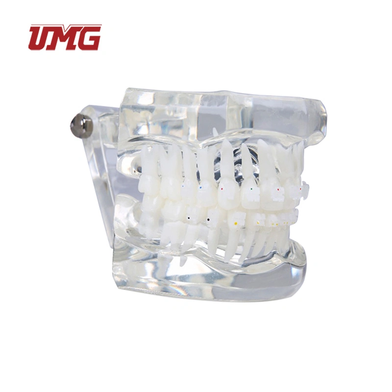 Transparent Dentition with Metal Brackets (3color) Dental Teaching Teeth Model