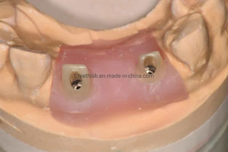 Kieferorthopädische Produkte Dental Material Supplies CAD Cam Dental Implant Crown Hergestellt in China Dental Lab