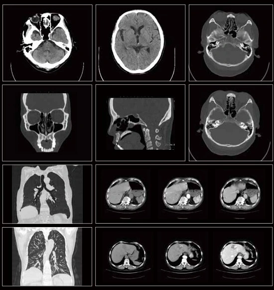 32-Slice CT Scanner (ScintCareBlue 755)