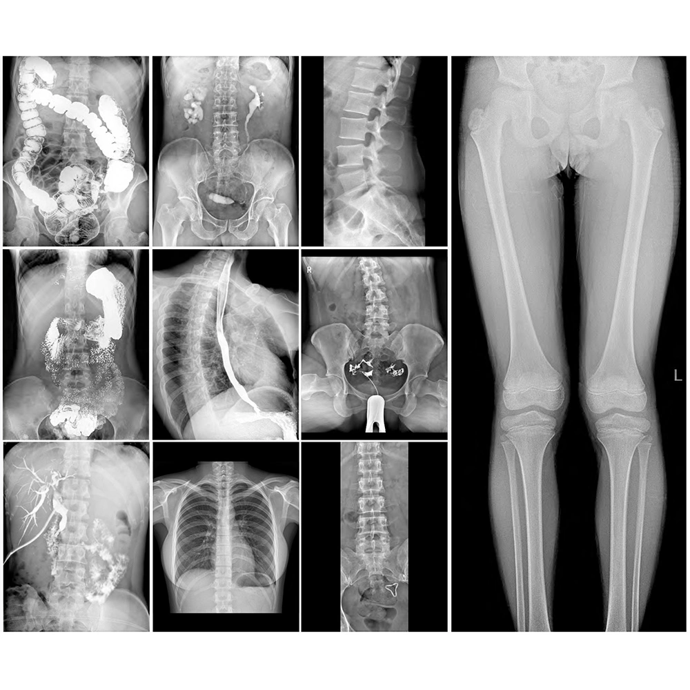 High Frequency Digital Dynamic Detector Radiography & Fluoroscopy X Ray System