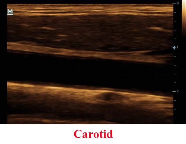 جهاز الموجات فوق الصوتية الرقمي المحمول Mindray DP-20 الأصلي مع Super Pw Doppler Image Mindray DP-20