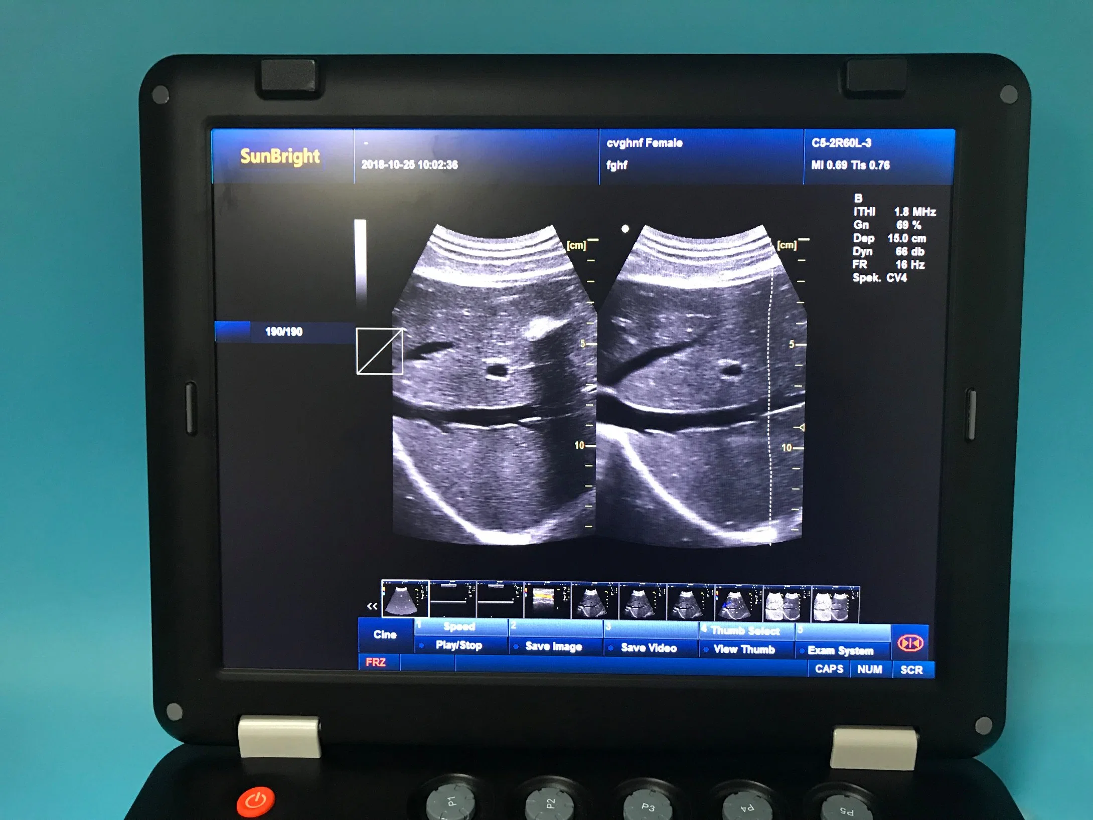 15 Inch Pw Auto Trace Measurement Color Doppler Ultrasound Medical Scanner