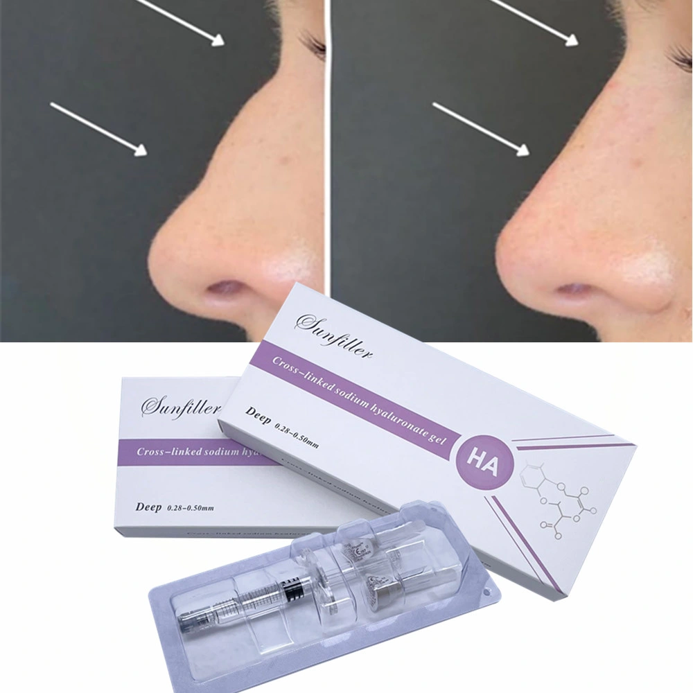 Sunfiller Injectable Hyaluronsäure Dermal Filler Acido Hialuronico Plastische Chirurgie Implantate für Nase, Lippen, Nasolabialfalten, Wangenverbesserung