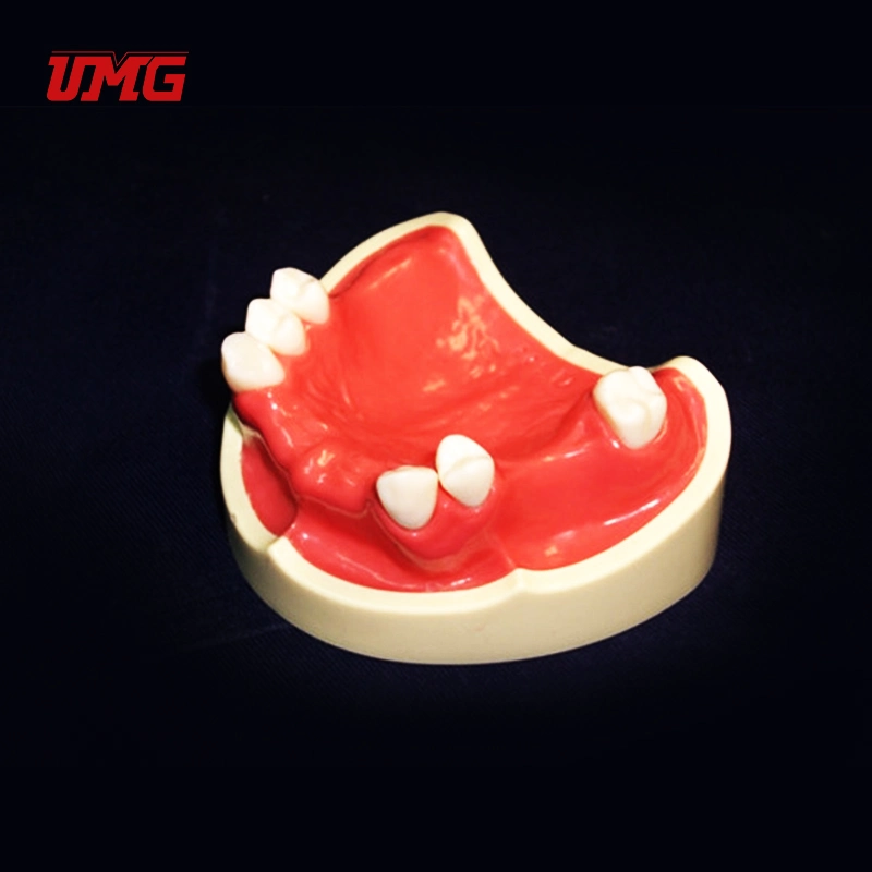 New Dental Educational Model Teeth Missing Model