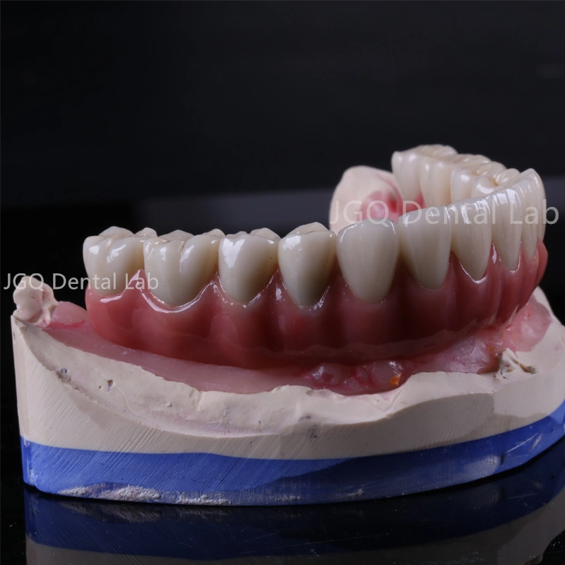 Implante Puente de Cemento - China Dental Lab Cemento Puente de implante, buena calidad, buena adaptación