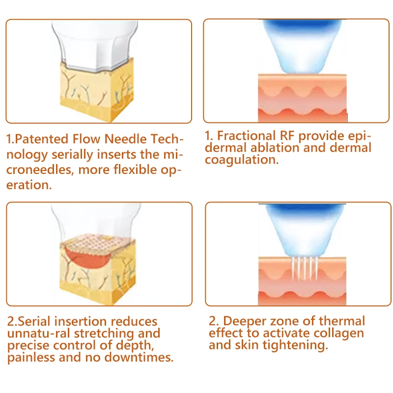 Micro-aiguille fractionnelle RF microneedle pour l'élimination des marques d'étirement