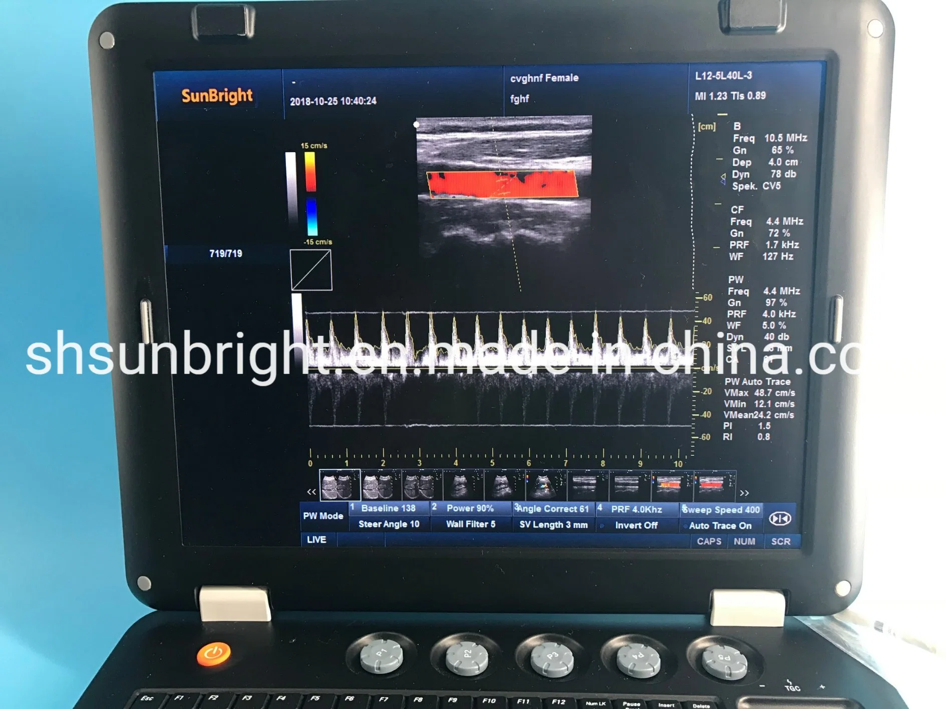 Sun-906A Doppler Ultrasound Laptop 3D 4D Color Doppler Ultrasound