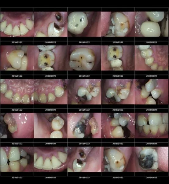 USB más vendido de la cámara Intra Oral Dental con Ce MD740