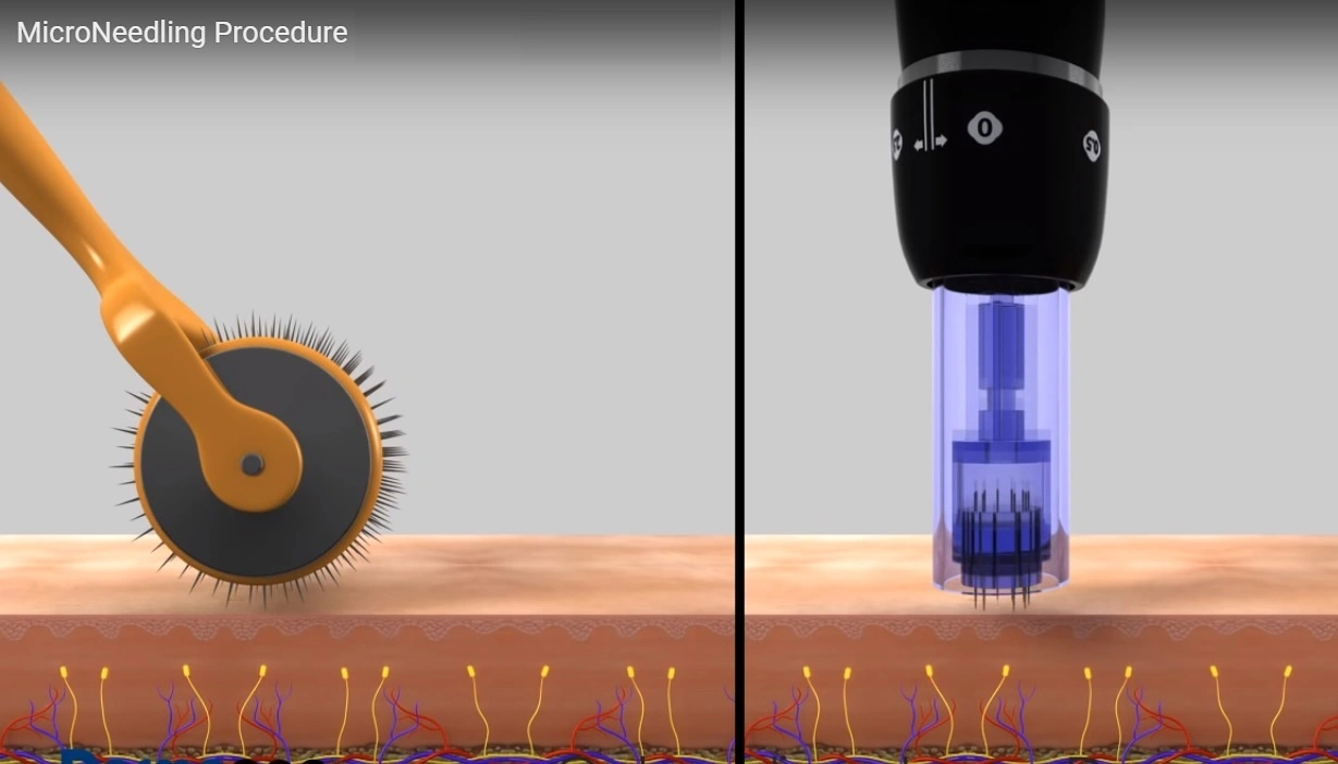 Solução de injeção de vitamina ácida Animo ácido hialurónico anti-rinkle Serum Branqueamento