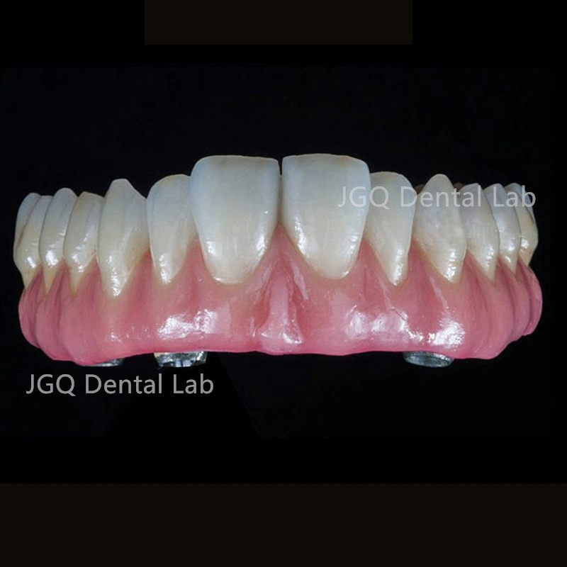 High Precise Dental Implant Tooth Full Ceramic Bridge with Pure Titanium Abutment