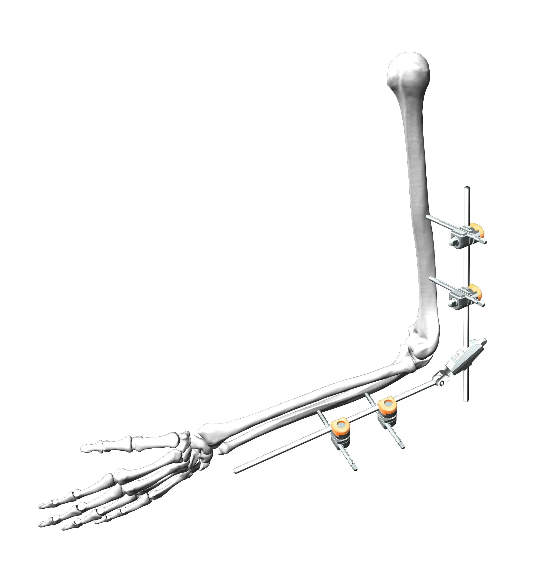 Orthopedic External Fixation Distal Radius Elbow Joint Fixation 5mm