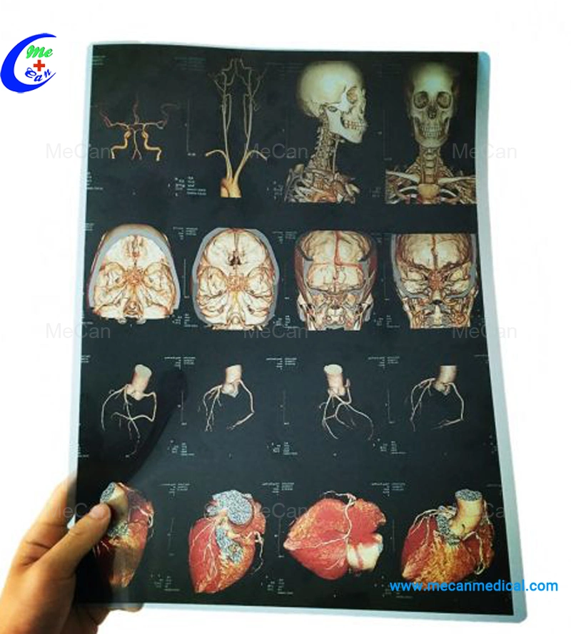 Radiology Medical Dry Inkjet X Ray Film for Hospital Film Printer