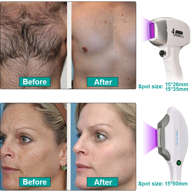 Best Selling Product 808nm Diode Laser 808nm Hair Removal Beauty and Personal Care Laser Machine Esthetician Equipment