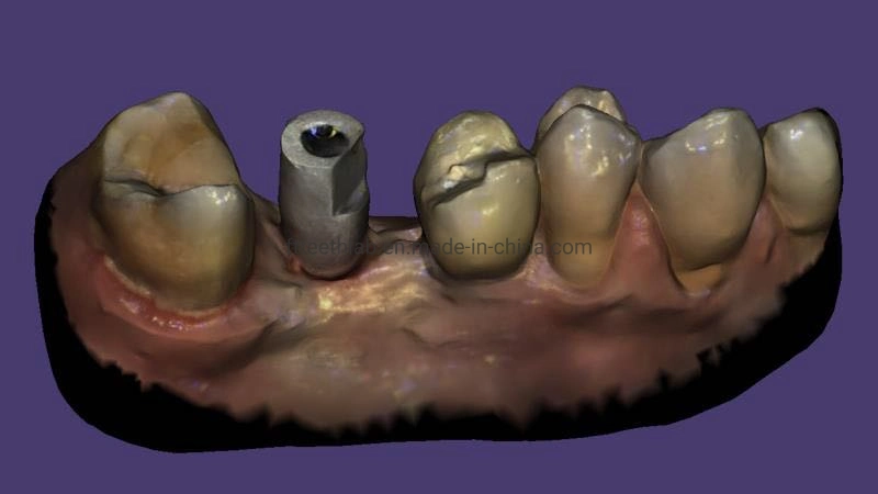 Digital Dental Implant Supplies Ceramiccrown Material Instrument Made From China Dental Lab Dental Implant