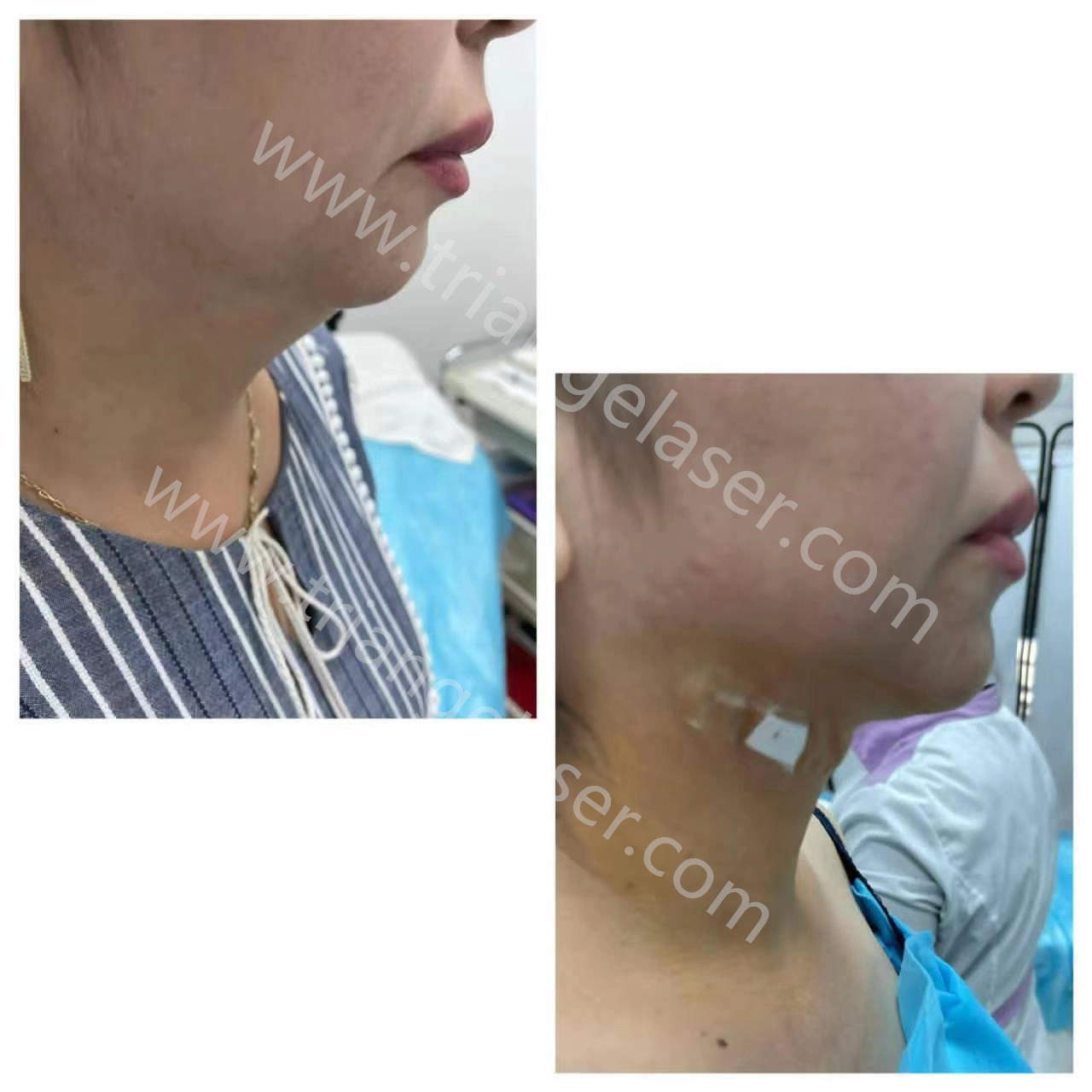 Laser Liposuction Maschine Medizinische Behandlung Haut Straffung Gesicht Lifting