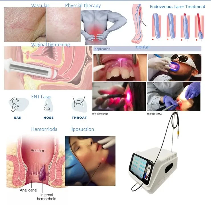 Laser minimamente invasivo 1470 tratamento de pilhas/fístula/varizes do seio pilonidal Dispositivo de remoção de hemorróidas