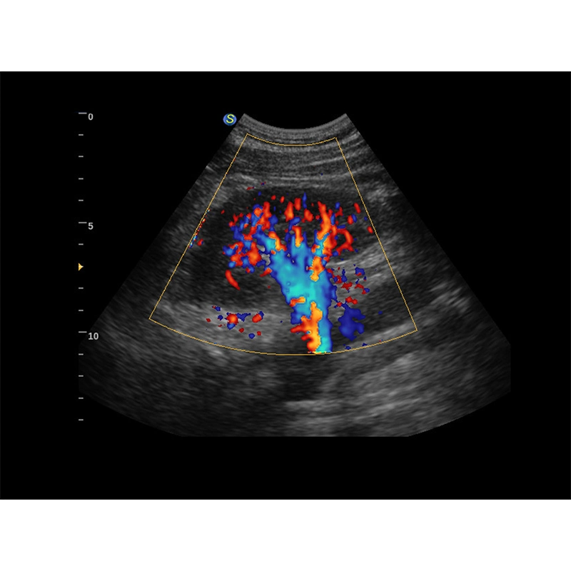Sonoscape P9 Equipo de diagnóstico por ultrasonido Carro digital Escáner de ultrasonido Doppler en color