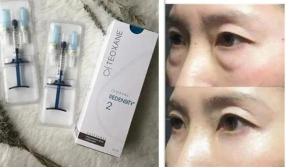 Enchimentos dérmica Teosyal Redensity 2 Teoxane Injecção de escuro nos círculos de olhos Puresense (2X1ml) Teoxane Remover Bolsas sob os olhos Olheiras depósito dérmico