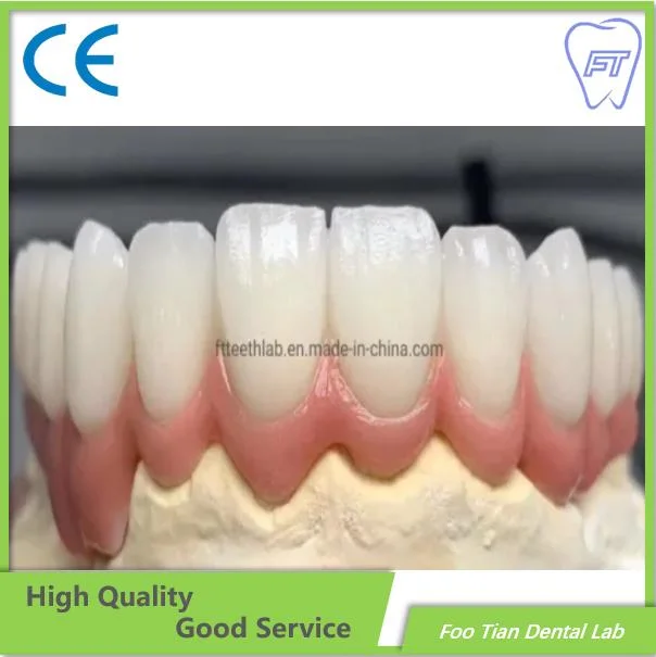 Tratamento odontológico Dental Coroa de cerâmica feitos de metal em Foo Tian Laboratório Dental Shenzhen China