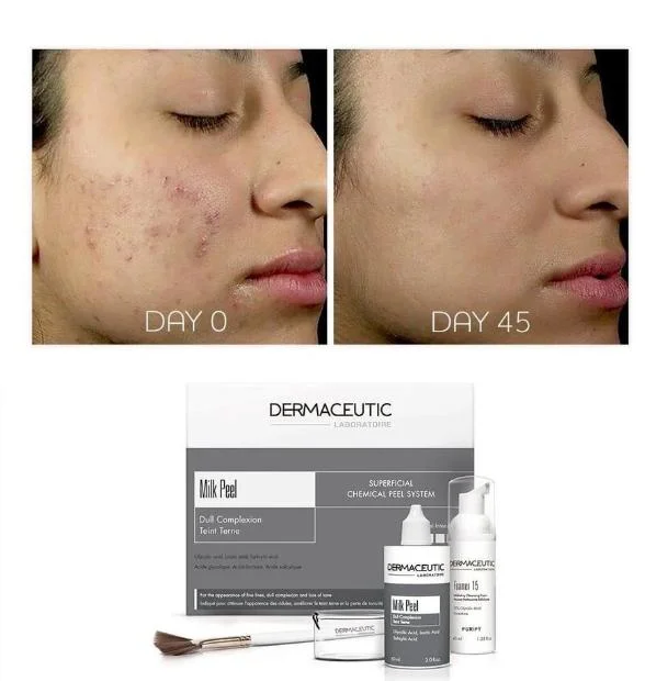 DermaceuticMilk отбеливание тела и осветление Acne метки, делающие Кожа блестящая