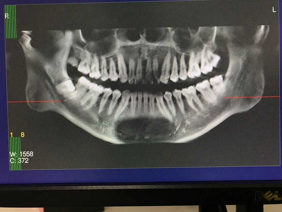 Equipo de imagen Dental Cephlometric Cbct máquina de rayos X panorámicos