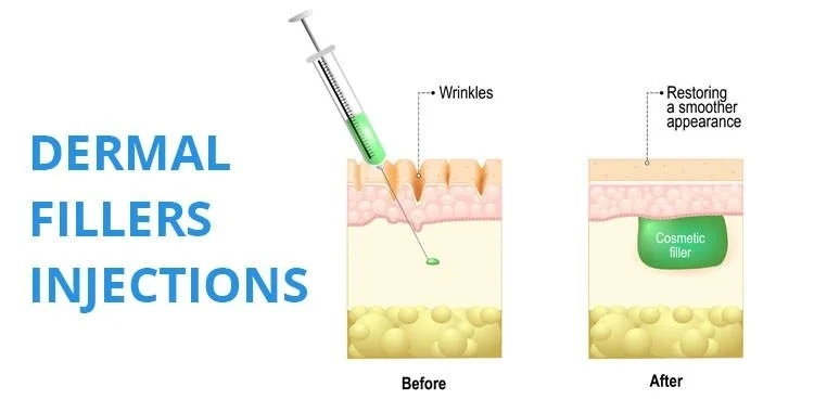 Loyoderm Injection Hyaluronat Acid Dermal Filler für Lip Fülle (2,0ml)