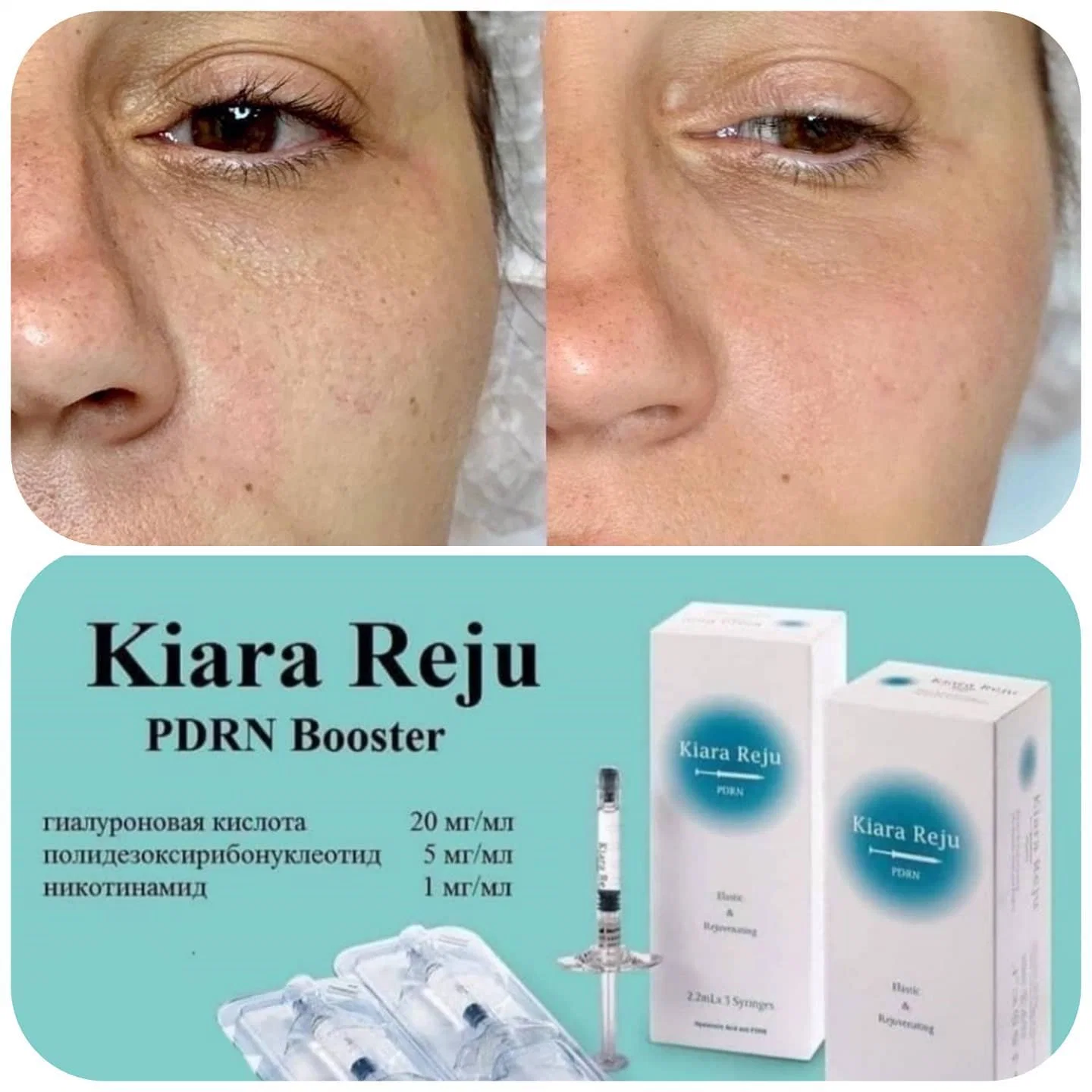 Comprar Kiara Reju Pdrn Skin Booster Hyaron H-DNA S-DNA Injection Ácido hialurônico Anti envelhecimento Mesoterapia DIY polinucleótidos PN Pdrn colágeno Rejuvenescimento da pele