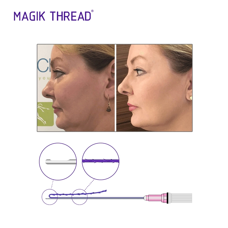 Hot Selling in America Skin Rejuvernation Face Lifting Thread Pdo with CE Approved