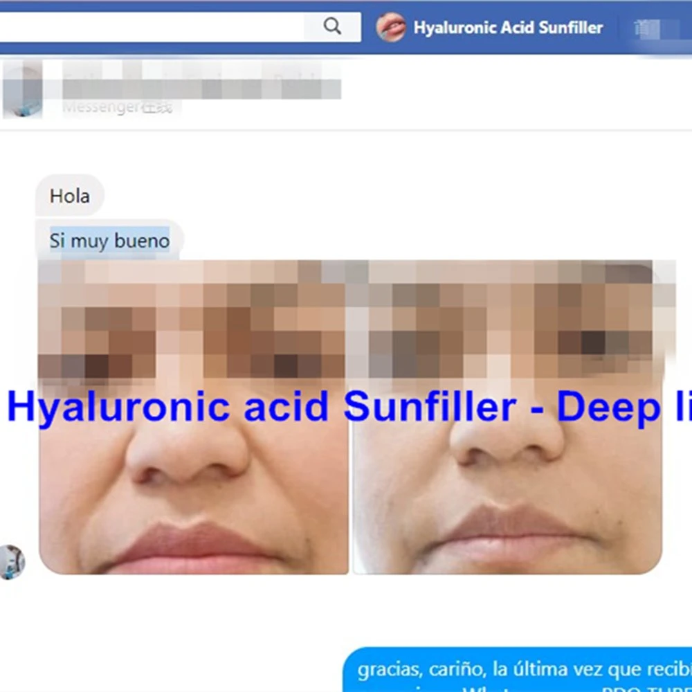 L'acide hyaluronique Injection cosmétiques Ha de remplissage pour Deep les rides du visage