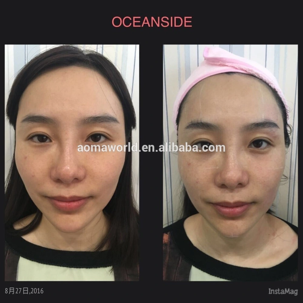 Otesaly 1ml Derm nez Lift peau Booster injection réticulé Acide hyaluronique Hyalgan Prix d'injection poitrine soutireuse