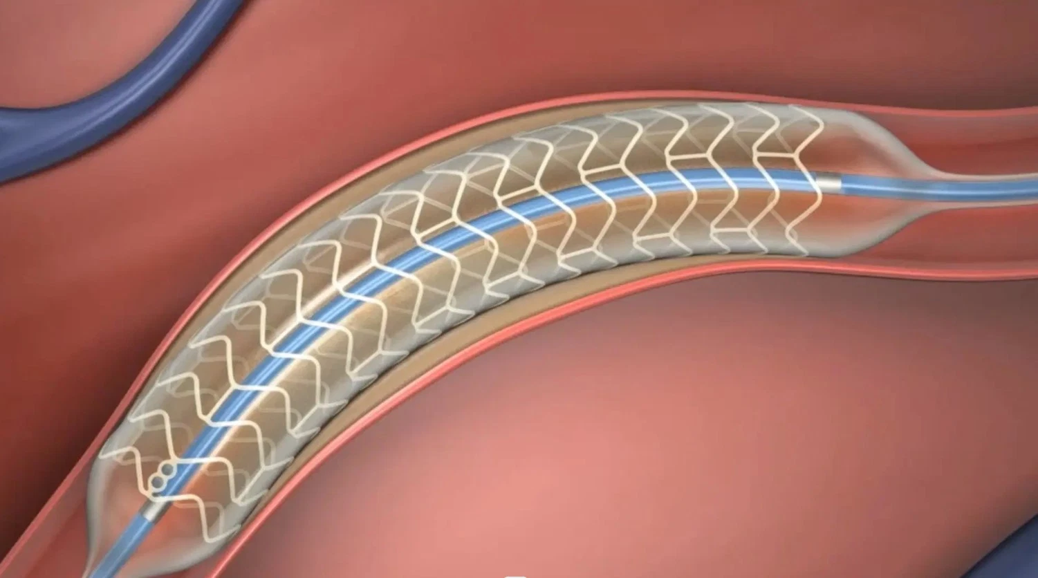 Médicos de alta calidad de elución de drogas cardiacas Stent coronario