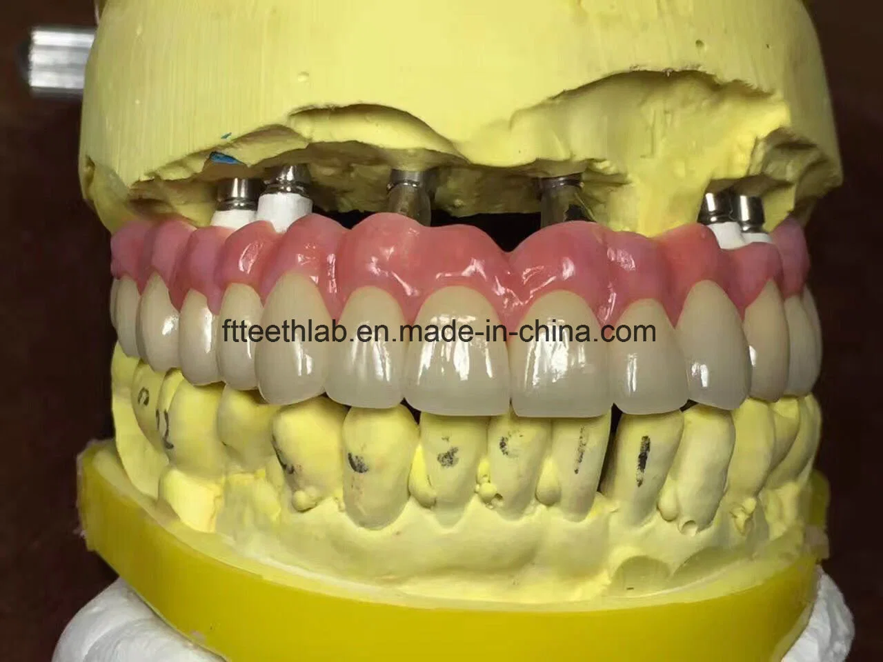 Dental Material Lab Implantat Dental Lab Lange Zirkonia Brücke Unterstützt Durch Implantate