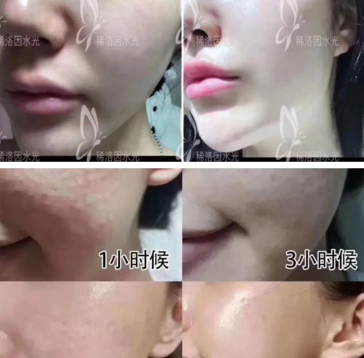 O Novo favorito do Departamento de Dermatologia no Distrito Jiangnan Healoine Luz de água recomendado pelos especialistas em Dermatologia, Custom-Made Coreano Luz água ele