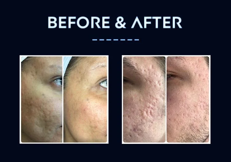 L'Acné Microneedling RF/SCAR/Ride/marque d'étirement dépose Rajeunissement de la peau