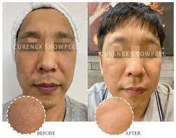 Strong Effect Curenex Snow Peel Simultaneous Peeling and Rejuvenating Chemical Peels Dead Skin Cell Hyaluronic Acid