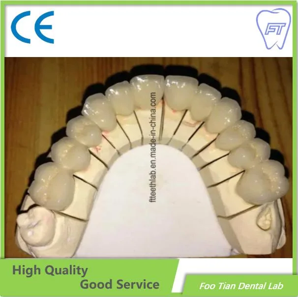 Dental Metal Ceramic Crown Dental Implant Customized