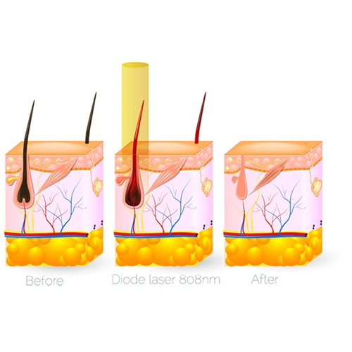 Épilateur à lumière pulsée sans douleur avec épilateur à lumière pulsée, option laser, épilateur à lumière pulsée, peau portable Machine de beauté rajeunissement