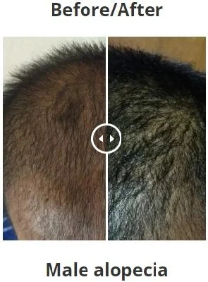 Inno-TDS Hair Vital Loss Control Treatment Male Pattern Baldness or Androgenic Alopecia Improve Scalp Health Reduce Hair Loss Promote The Growth of New Hair