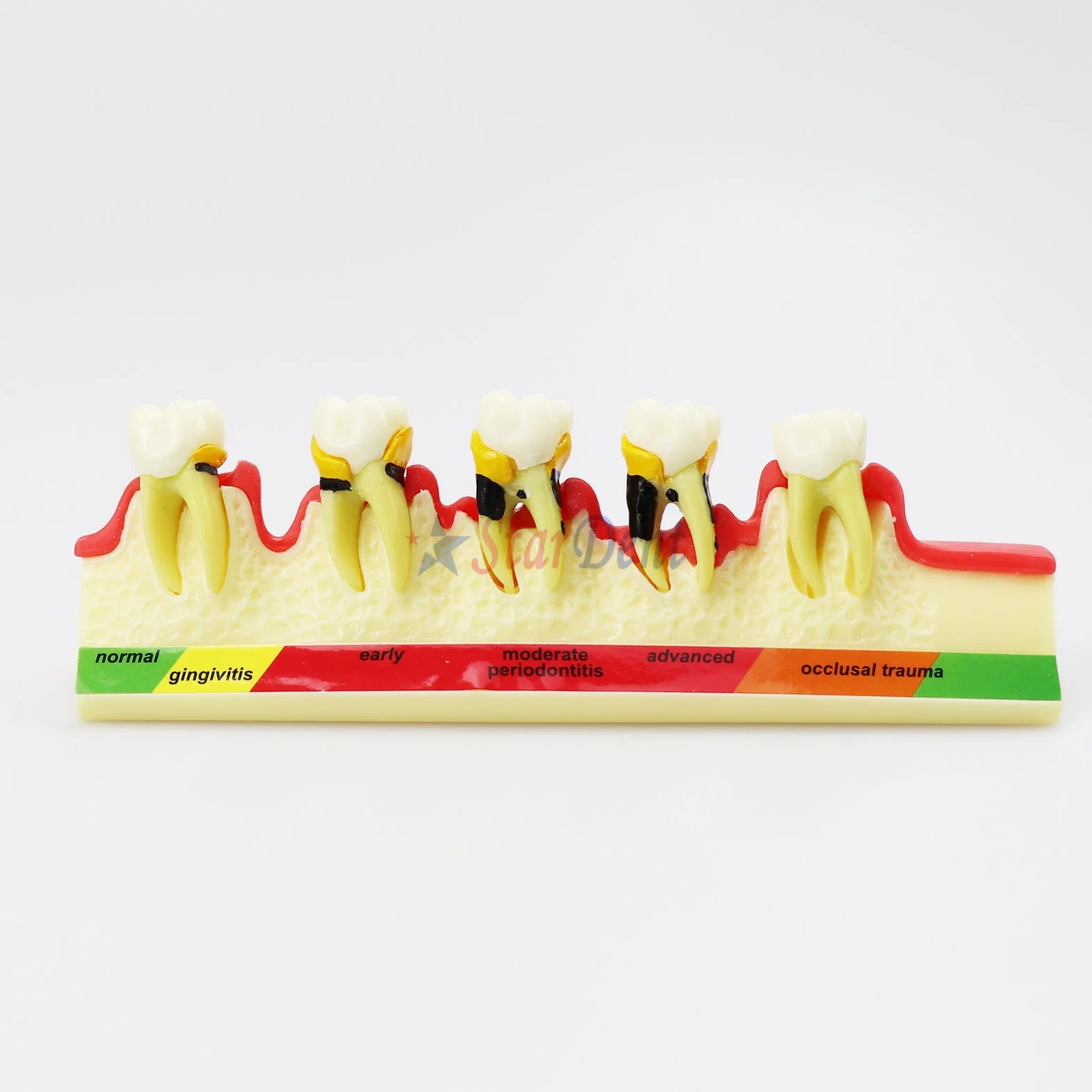 Dental Periodontal Disease Model Demonstrates The Progress of Periodontal Disease Dental Resin Teeth for Teaching