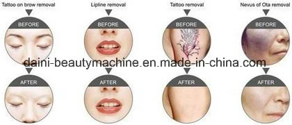 Specialized in Tattoo Removal Q Switch ND YAG Medical Laser Korea