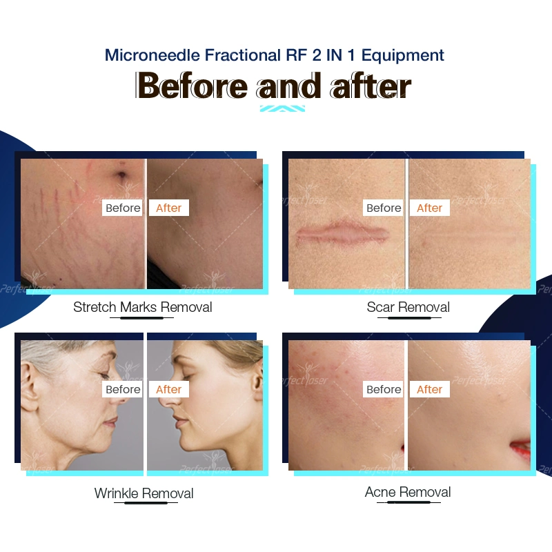 MFR Sfr RF Rejuvenecimiento de la piel aguja ajustable profundidad Micón microneedling Aguja