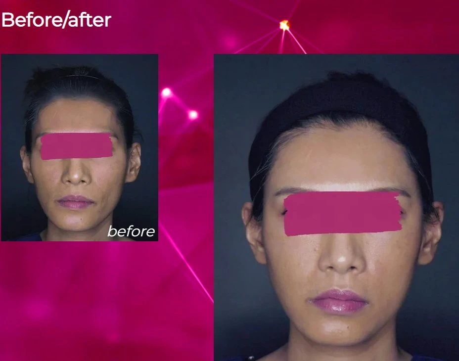 Korea Products Beliebteste Gesichtsfüllung Aesthe Fill Poly L Milchsäure Pdlla Injection Dermal Filler für Gesicht Haut trocken Feine Falten und Nasolabialfalten