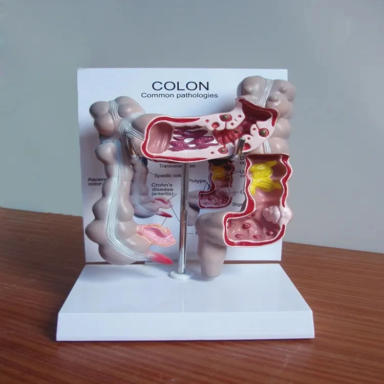 High quality/High cost performance  Medical Diseases Colon Model