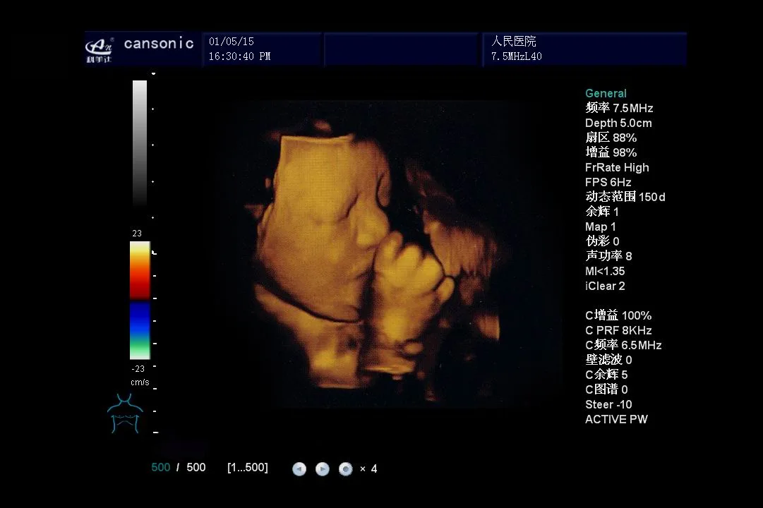 Échographie Doppler couleur 4D sur chariot (K10)