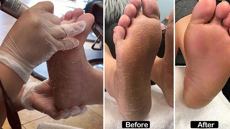 Calo elétrico portátil Remove foot moedor recarregável pedicure de arquivo de pé Ferramentas pés eletrónicos cuidado de esfreada