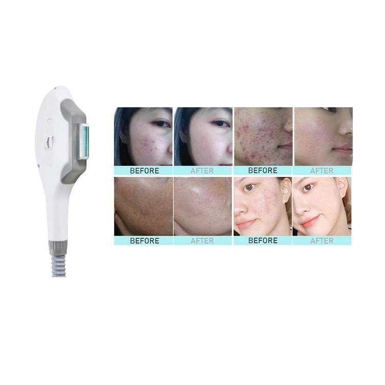 4 in 1 Laser RF Beauty Machine 808nm Diode Laser + Tattoo Removal ND YAG Laser + Dpl Hair Removal
